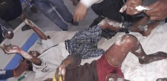 बच्‍चे झुलसे