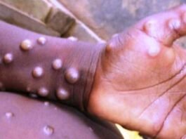 मंकी पॉक्स