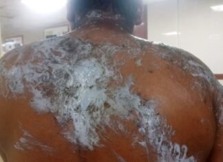 छात्रा पर एसिड अटैक