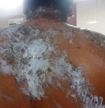 छात्रा पर एसिड अटैक